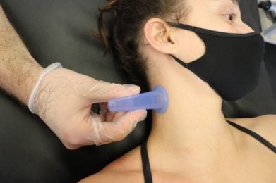Cupping lateral cervical